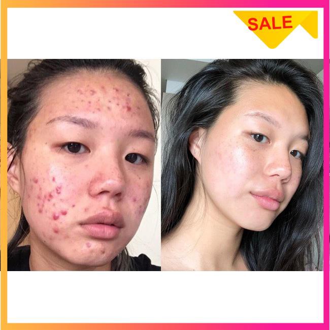 [SIÊU KHYẾN MÃI]Serum Skin 7 Days giảm mụn thâm - chống lão hóa hiệu quả sau 7 ngày | BigBuy360 - bigbuy360.vn