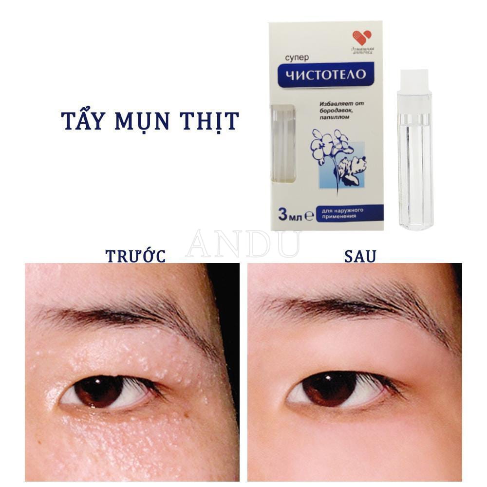 Gel Tẩy Nốt Duồi Dvelinil ,Gel Tẩy Sẹo, Tàn Nhang, Mụn Cóc , Mụn Thịt