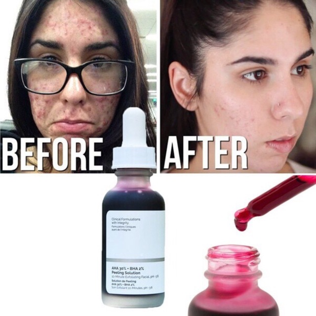 Tẩy da chết the Ordinary AHA 30% + BHA 2% Peeling Solution