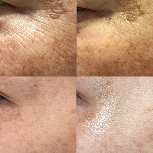 Chỉ Tơ Căng Da Chitossil Esthemax Hàn Quốc