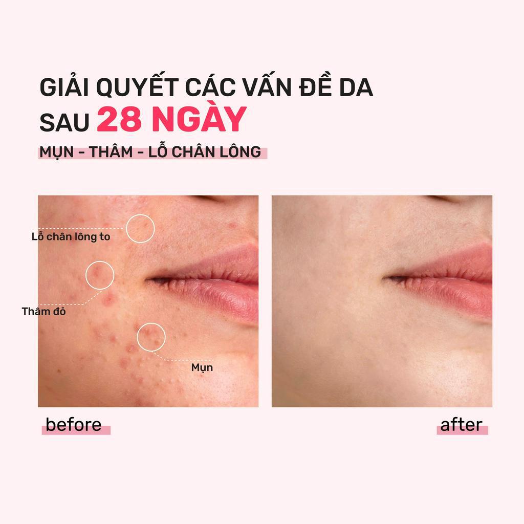 Tinh chất giảm mụn, se lỗ chân lông Derladie Pore Tightening Ampoule Niacinamide 20%+ ZinC PCA 1% 30ml