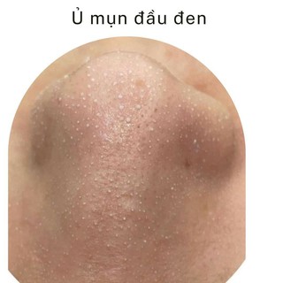 gel ủ đẩy mụn đầu đen