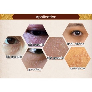KEM MỤN THỊT GENTITAN EYE CREAM