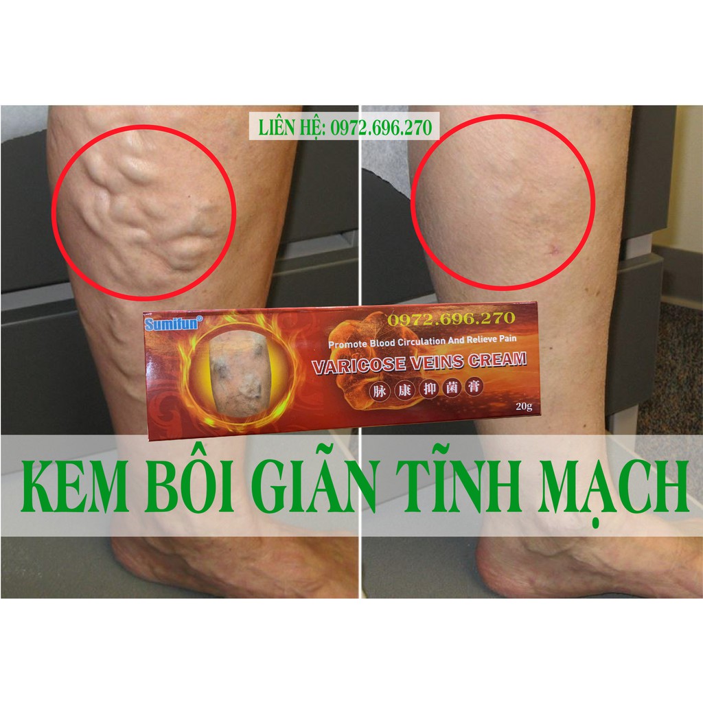 Kem bôi giãn tĩnh mạch Sumifun [ Cực hiệu quả ]