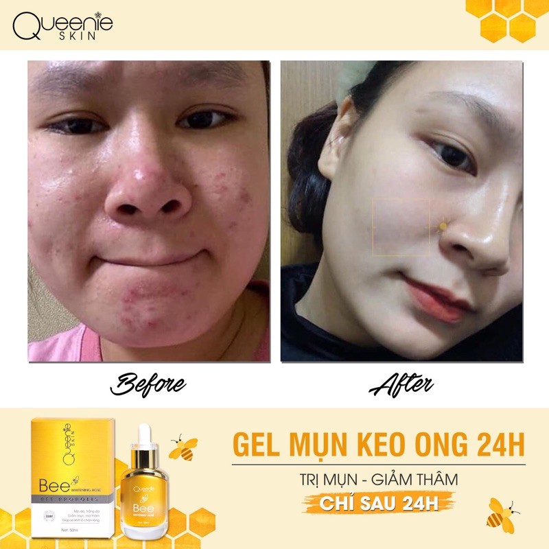 GEL MỤN KEO ONG | BigBuy360 - bigbuy360.vn