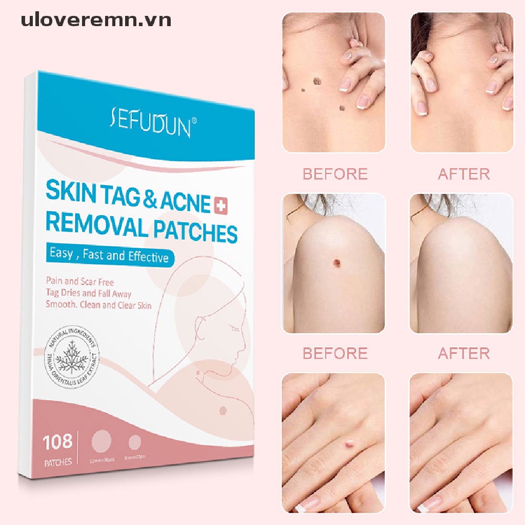 Bộ 108 Miếng Dán Loại Bỏ Mụn Trứng Cá / Mụn Trứng Cá Tiện Dụng