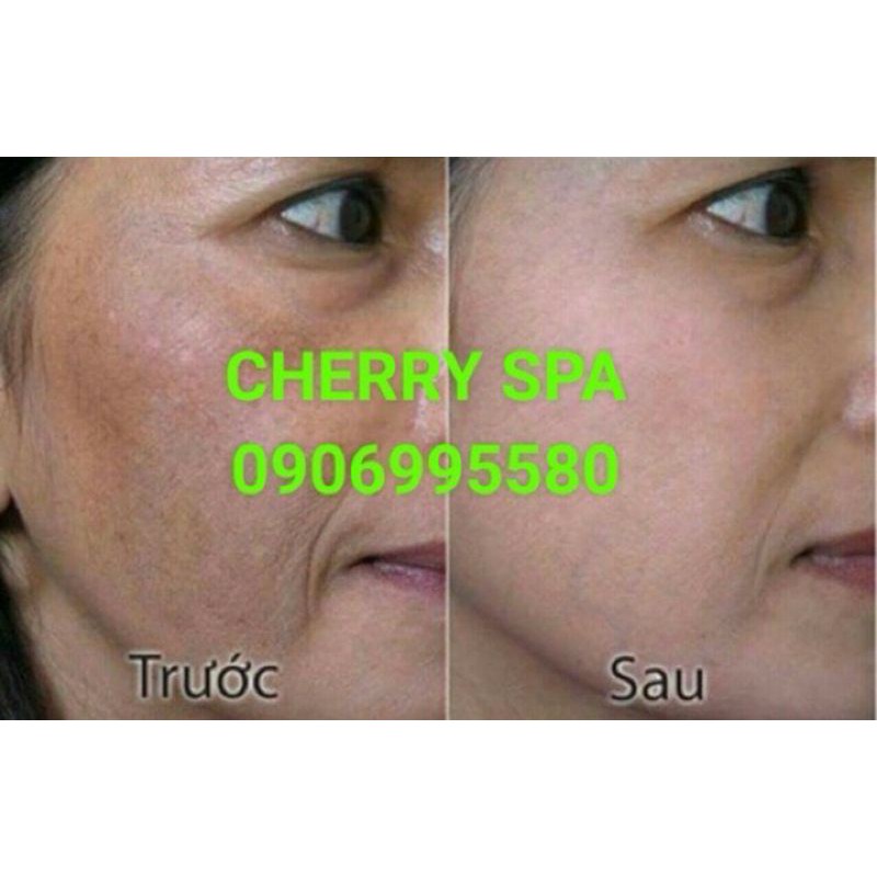 KEM NGỪA NÁM TÀN NHANG ĐỒI MỒI TRẮNG DA CHỐNG NẮNG Lynshao 12g đủ hóa đơn