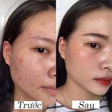 Serum giảm mụn sẹo thâm rỗ LP-II Hàng Chính Hãng | BigBuy360 - bigbuy360.vn