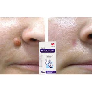 Gel tẩy nốt ruồi, mụn cóc