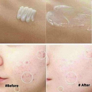 Tuýp trị mụn innisfree