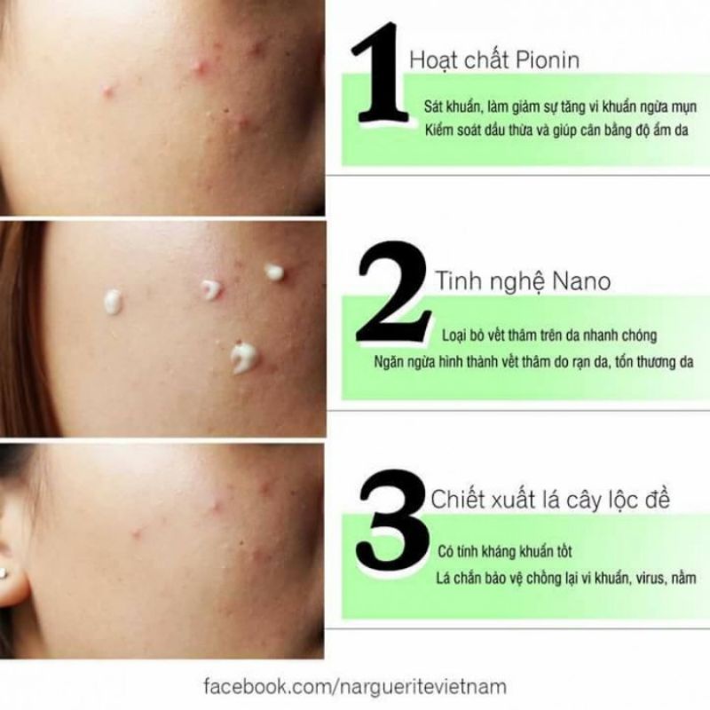 NHŨ TƯƠNG GIẢM MỤN, NGỪA DẦU NARGUERITE (30ML) | BigBuy360 - bigbuy360.vn