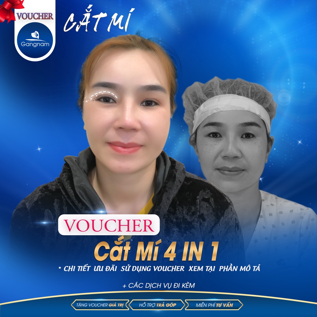 Cắt Mí 4 in 1 | Thẩm Mỹ Viện Gangnam