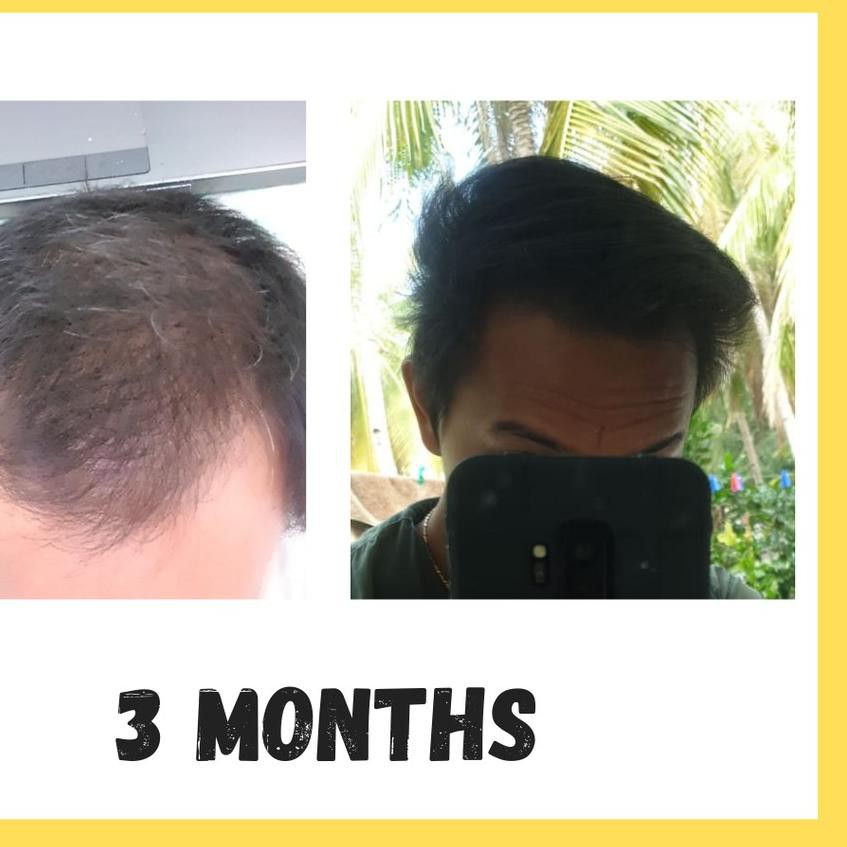 (Hot) Finmix (Topical Finasteride + Minoxidil) Lou-770