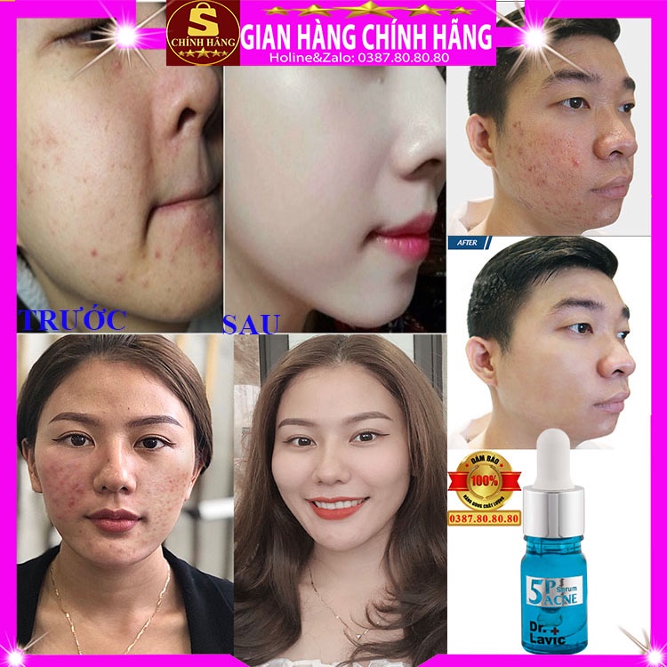 Tinh chất serum xóa mụn thâm dưỡng trắng da loại tốt 5P Dr.lavic đẩy mụn ẩn đầu đen cám cho da dầu nhạy cảm khô 5k step2