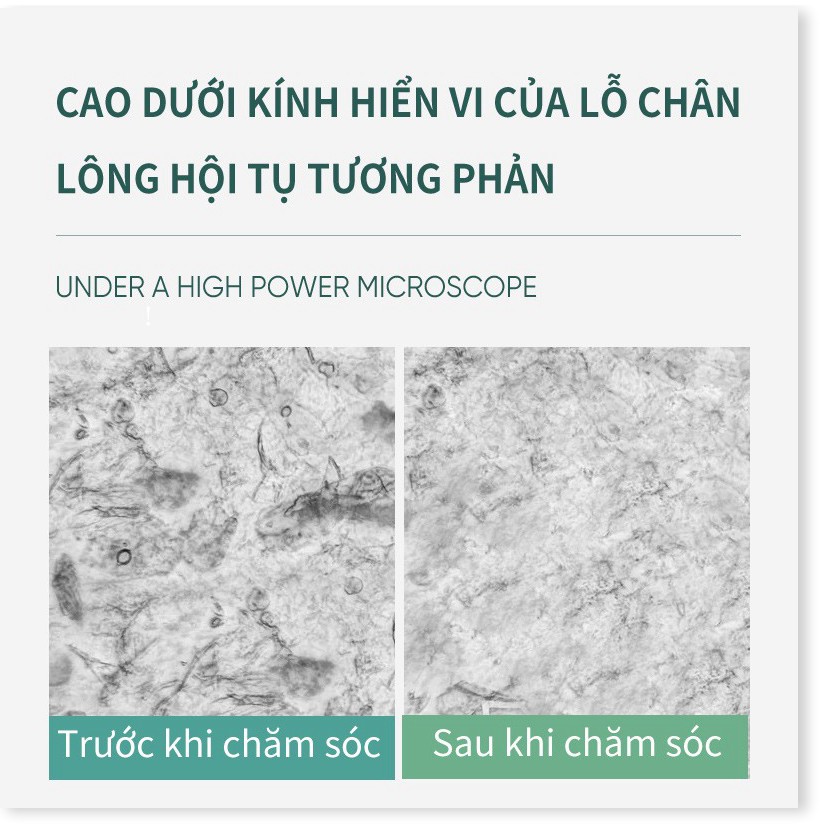 Bộ Tinh Chất Chăm Sóc Cải Thiện Mụn Đầu Đen Soon Pure Se Khít Lỗ Chân Lông 22g | BigBuy360 - bigbuy360.vn