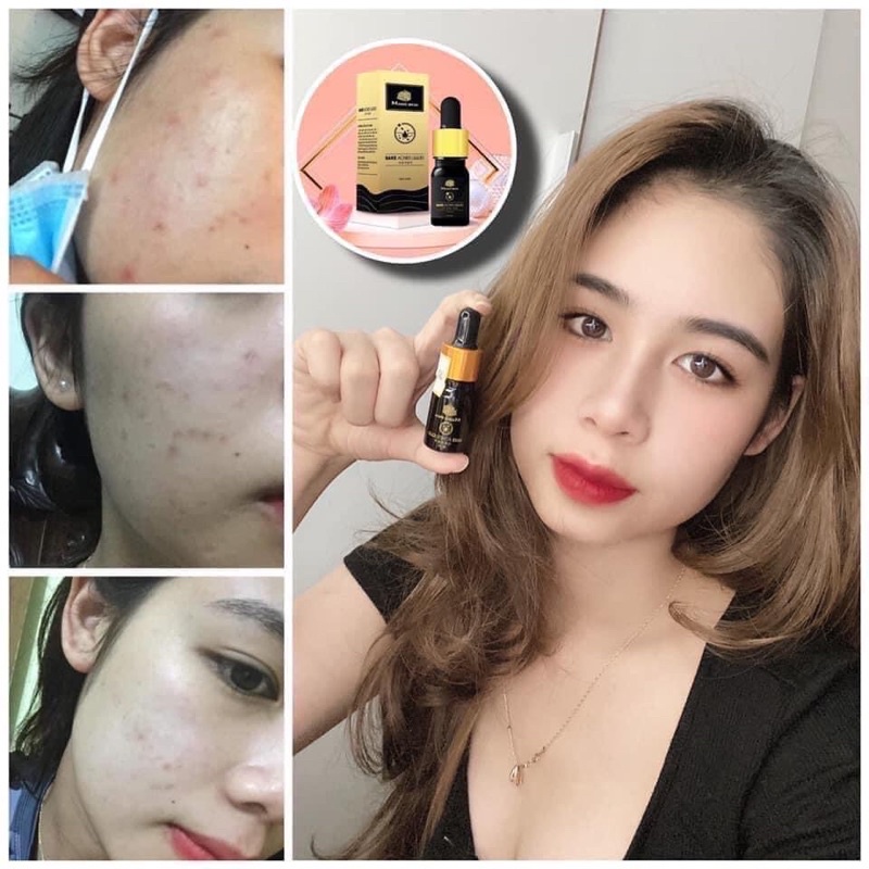 Serum ngừa mụn không sưng cốt rượu sake Sake Acnes Liquid Magic Skin