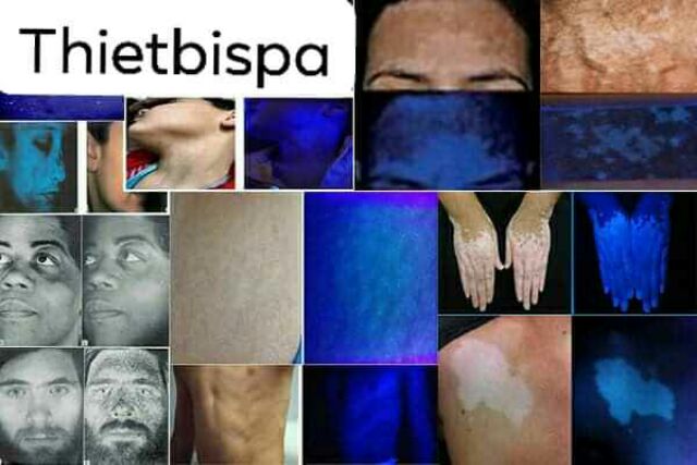 ĐÈN WOODD SOI,  PHÂN TÍCH DA DÀNH CHO SPA,  THẨM MỸ VIỆN