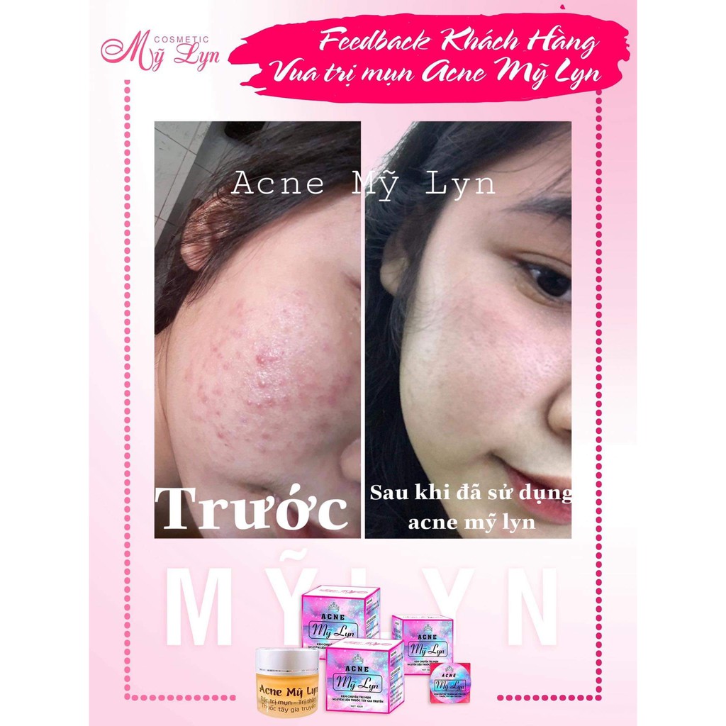 Kem Mụn Acne Mỹ Lyn hủ 5 gram - 10 gram