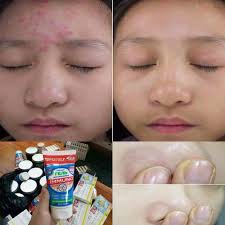 Sữa rửa mặt cho da mụn Immuno date mới nhất - Sữa rửa mặt giảm mụn nga | BigBuy360 - bigbuy360.vn