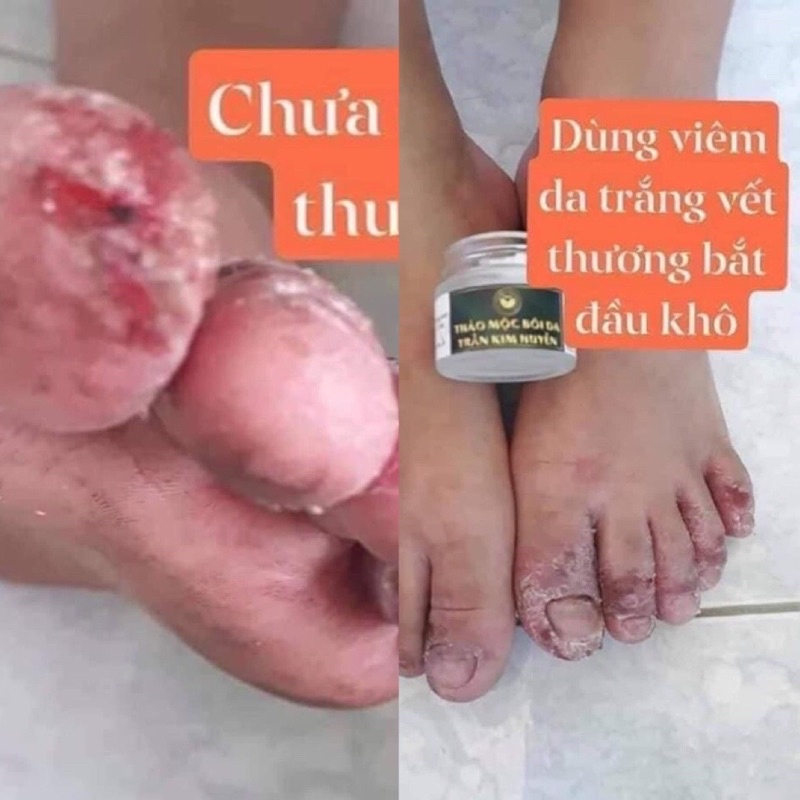 Bôi Da Lở Loét -Viêm Da trắng Trần kim huyền