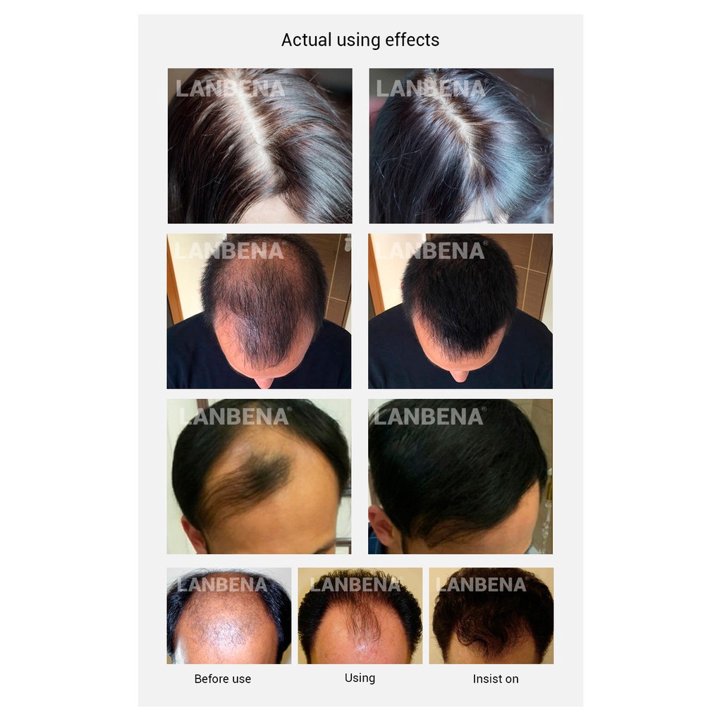 Tinh Chất Xịt Dưỡng Tóc LANBENA Chăm Sóc Gốc Tóc Chống Rụng Chống Hói Đầu 20ml | BigBuy360 - bigbuy360.vn