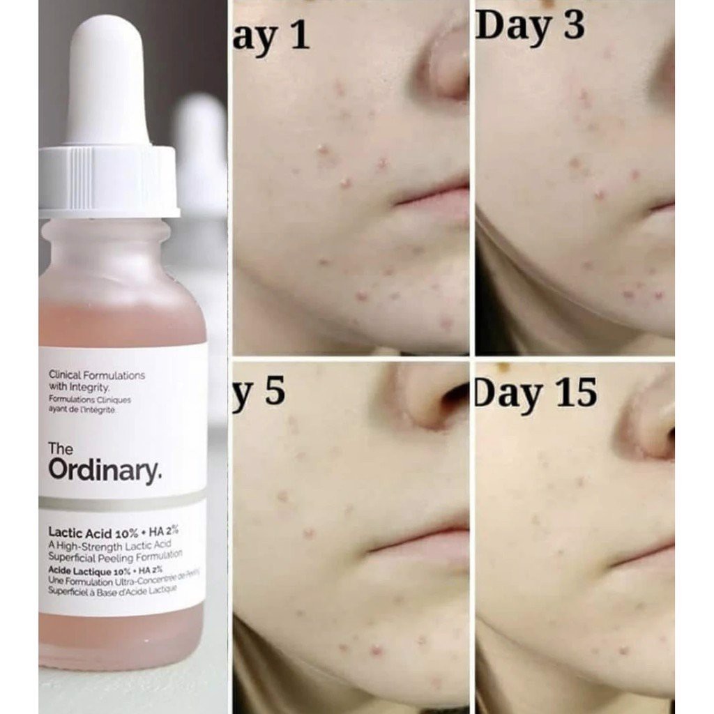 (Bill Canada)Tinh chất Serum Sáng Da Lactic Acid 5% ,10% +HA -The Ordinary