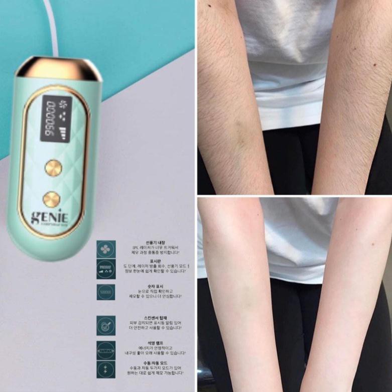 MÁY LÔNG LASER IPL GENIE HÀN QUỐC