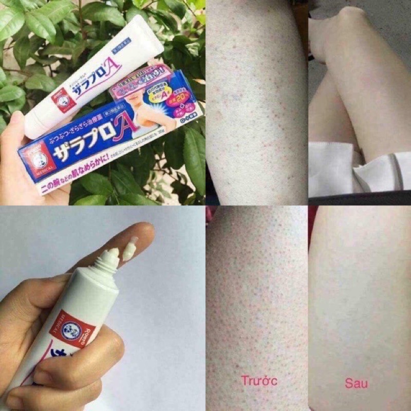 nội địa Nhật - Kem viêm nang lông Rohto Zaraporo 35g