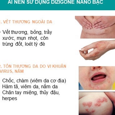 Kem Bôi Dizigone Nano Bạc 25g - Kháng Khuẩn, Lành Vết Thương, Tái Tạo Da, Ngăn Ngừa Sẹo