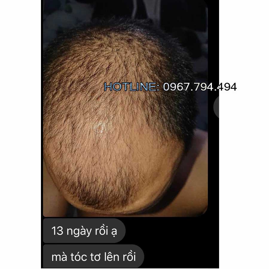 Thuốc mọc tóc Morr F5 ( Minoxidil 5% + Finasteride )