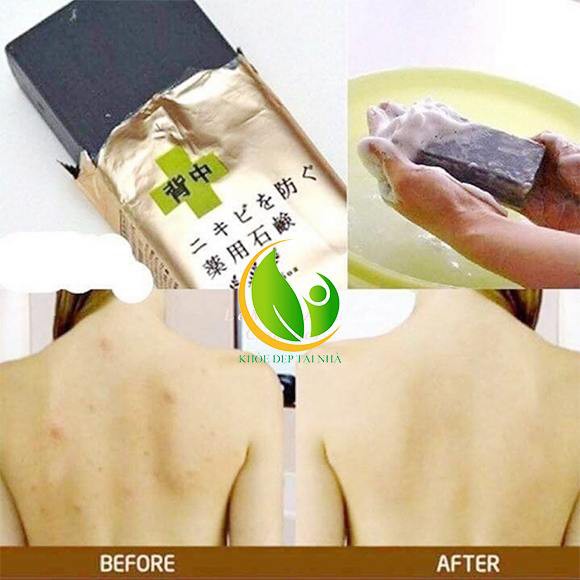 [ CHÍNH HÃNG ] Xà Phòng Ngừa Mụn Lưng FOR BACK SOAP 135g