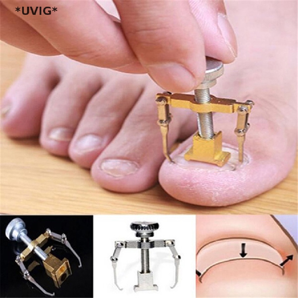 [[UVIG]] Ingrown toenail correction tool, foot care tool for pedicure, easy to use [Hot Sell]