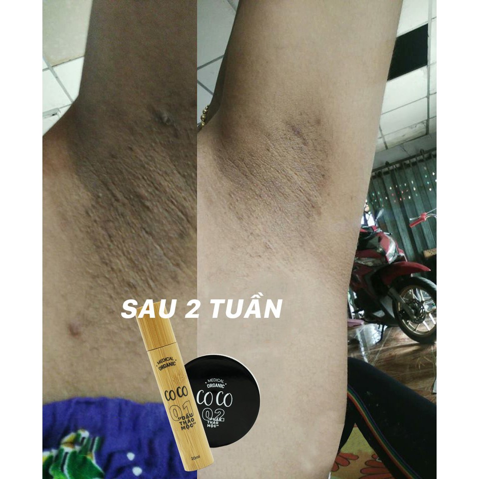 Liệu trình trị hôi nách CoCo | BigBuy360 - bigbuy360.vn