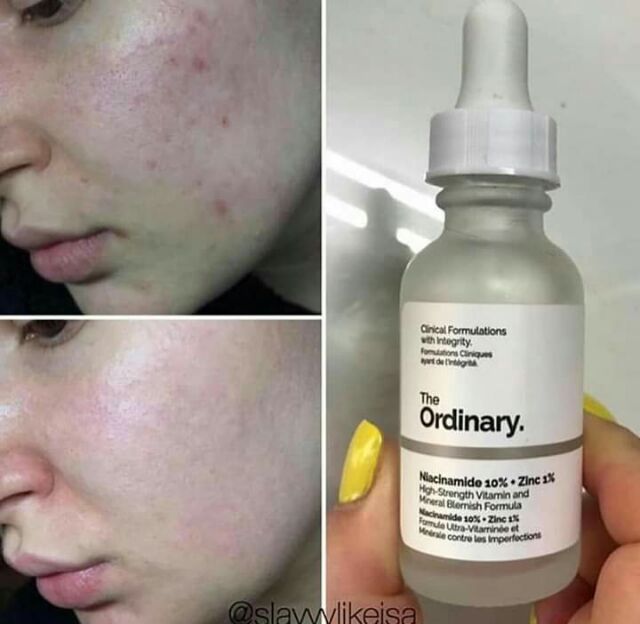 The Ordinary serum Niacinamid 10% + Zin C 1%  giảm mụn, giảm thâm mụn  , se lỗ chân lông