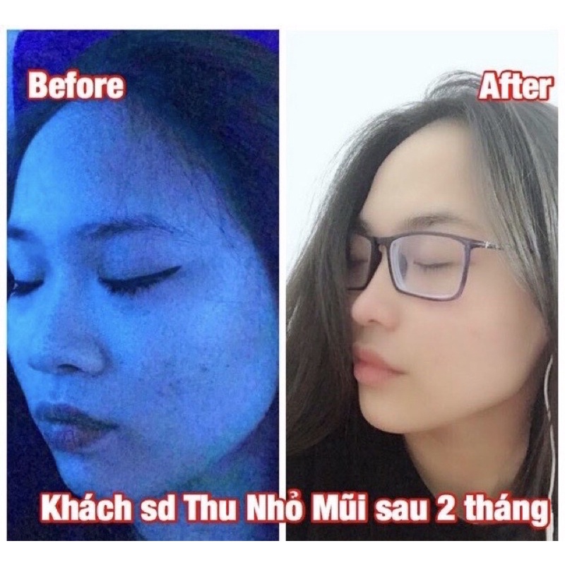 Tinh chất Miracle Pháp thu nhỏ cánh mũi, hiệu quả chỉ sau 14 ngày