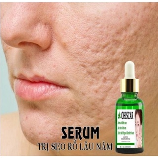 Serum Sẹo Rổ OHISCAR