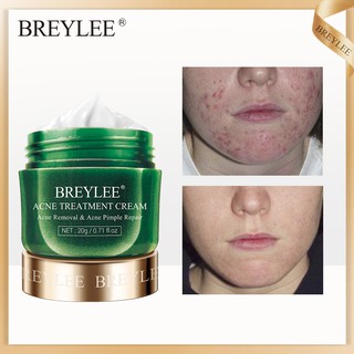 Kem Hỗ Trợ Giảm mụn đầu đen se khít lỗ chân lông hiệu quả Breylee