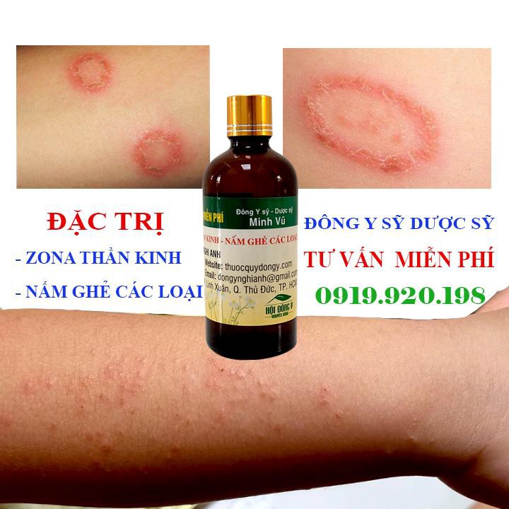 02 CHAI DƯỢC PHẨM CHỮA ZONA THẦN KINH, NGỨA DỊ ỨNG, GHẺ NƯỚC CỰC HIỆU QUẢ CỦA ĐÔNG Y NGHI ANH