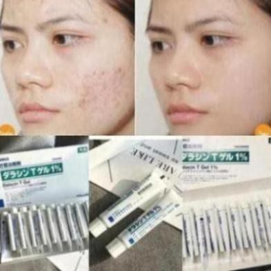 Kem ngừa mụn, ngăn sẹo Gentacin Takata Gentamicine Nhật Bản | BigBuy360 - bigbuy360.vn