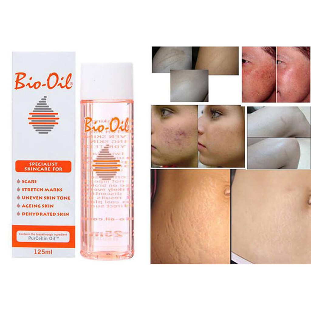 Bio-Oil Giảm Rạn Da Và Làm Mờ Sẹo - Khongcoson