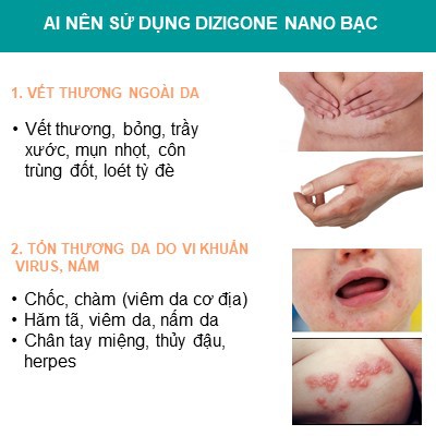 Kem Bôi Dizigone Nano Bạc 25g - Kháng Khuẩn, Lành Vết Thương, Tái Tạo Da, Ngăn Ngừa Sẹo