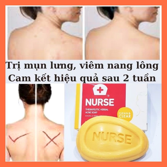 Xà Phòng Loại Bỏ Mụn Lưng Thương Hiệu NURSE Thái Lan