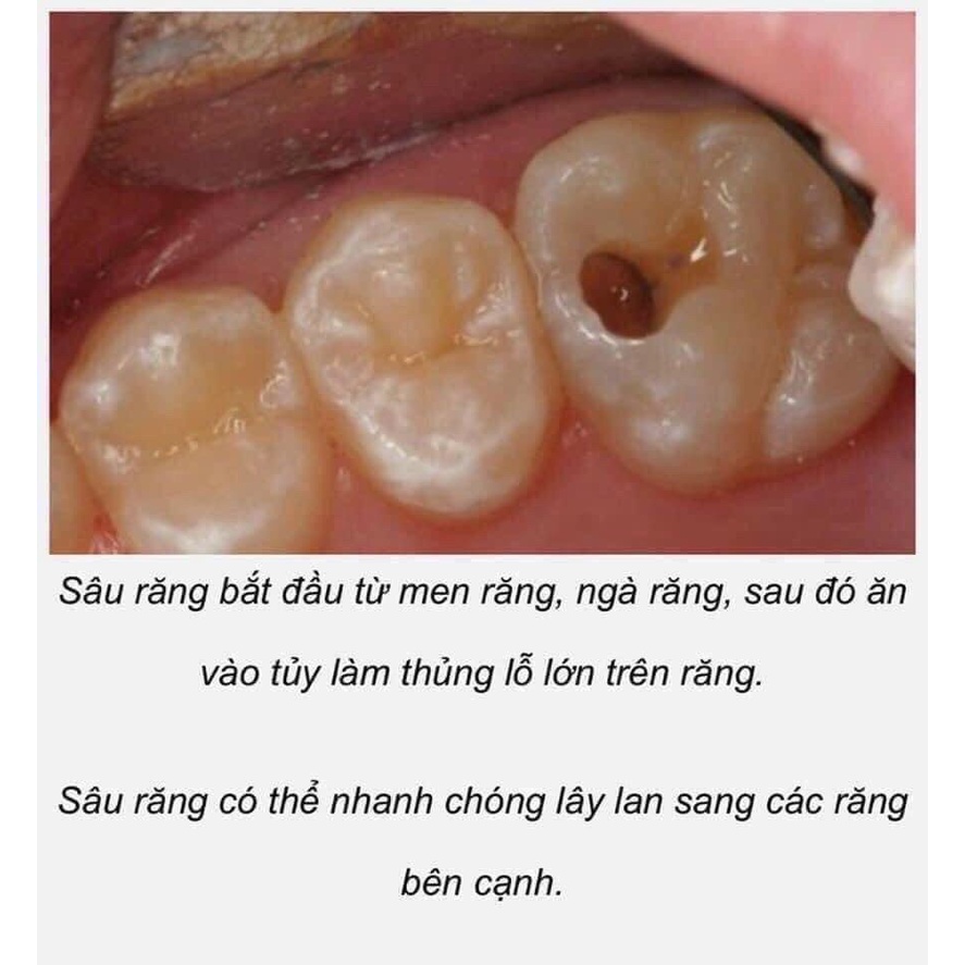 Dầu bôi đau răng M16 Patar 75 3ml