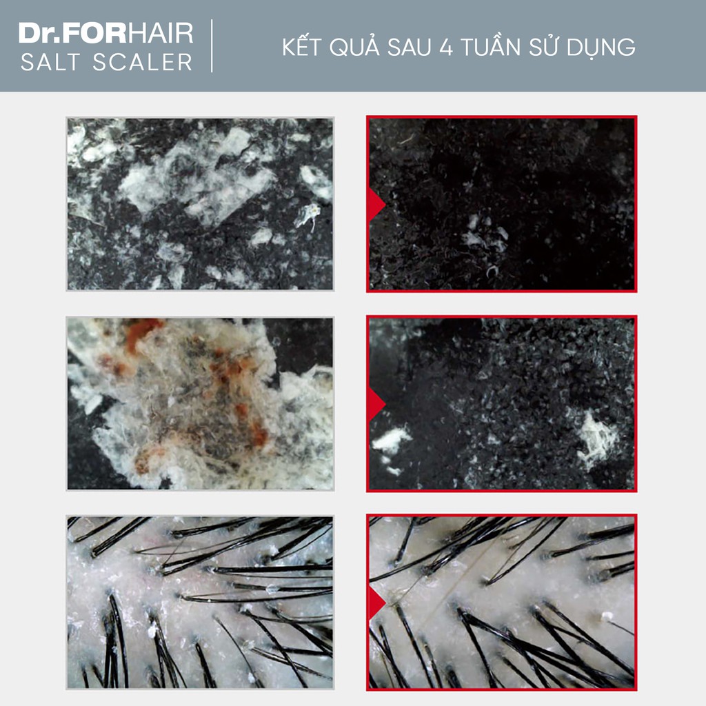 Bộ Dầu Gội Tẩy Tế Bào Chết Dr.FORHAIR/Dr For Hair Sạch Gàu, Giảm Rụng Tóc Và Kích Mọc Tóc