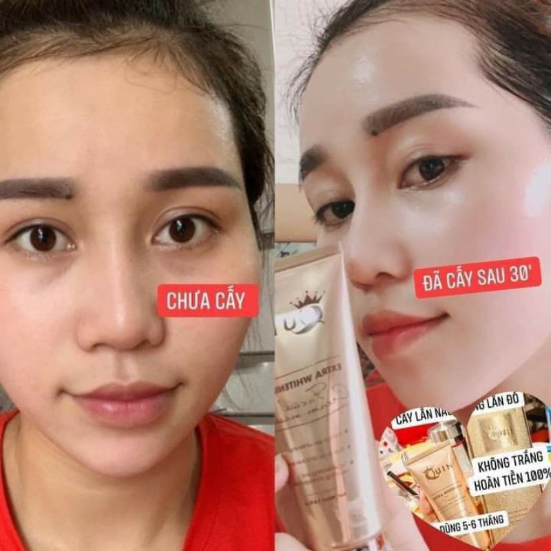 CẤY TRẮNG FACE QUIN TRẮNG HỒNG RẠNG RỠ 100% CHÍNH HÃNG | BigBuy360 - bigbuy360.vn