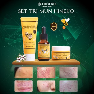 𝐊𝐞𝐦 𝐭𝐡𝐚̉𝐨 𝐝𝐮̛𝐨̛̣𝐜 𝐭𝐫𝐢̣ 𝐦𝐮̣𝐧 𝐦𝐚̣̂𝐭 𝐨𝐧𝐠 𝐌𝐚𝐧𝐮𝐤𝐚,  Hineko 100% nhập khẩu Nhật Bản