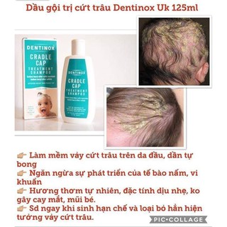Dầu gội trị cứt trâu Dentinox UK 125ml cho bé từ sơ sinh