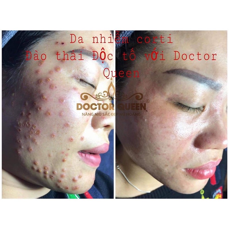 serum tri mụn doctor queen