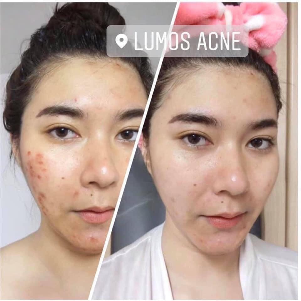 [Chính hãng+có tem] SERUM LUMOS ACNE XOÁ TAN NỖI LO THÂM MỤN | BigBuy360 - bigbuy360.vn