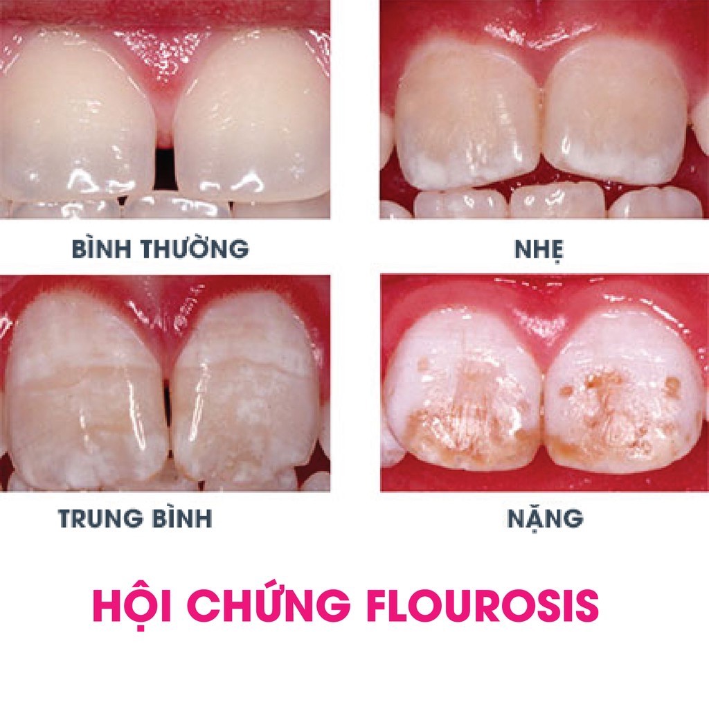 Raxinic (Chính hãng) - Gel ngừa sâu răng, nhiệt miệng. Tặng bàn chải xỏ ngón